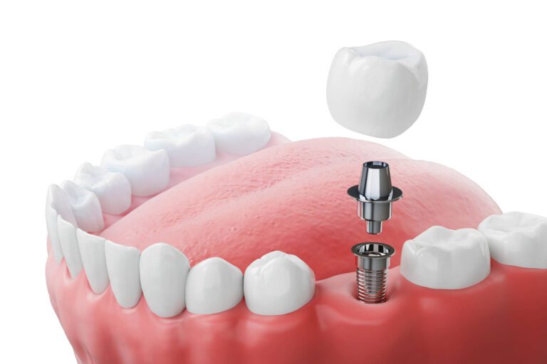 Izguba enega zoba- Možnosti nadomestitve in estetske prednosti